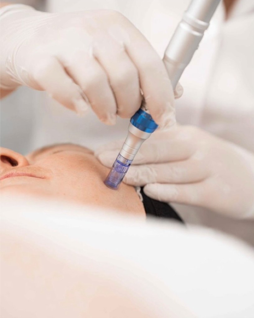 Mikronõelumine professionaalse dermapeniga näol